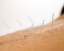 acupuncture